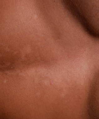 Mide cilt üzerinde güneş yanığı. Pul pul dökülme, cilt peeling. Tehlikeli güneş tan