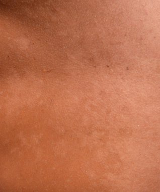 Arka ciltte güneş yanığı. Pul pul dökülme, cilt peeling. Tehlikeli güneş tan