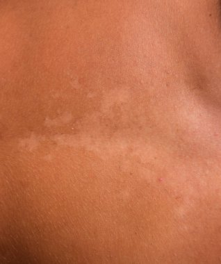 Mide cilt üzerinde güneş yanığı. Pul pul dökülme, cilt peeling. Tehlikeli güneş tan