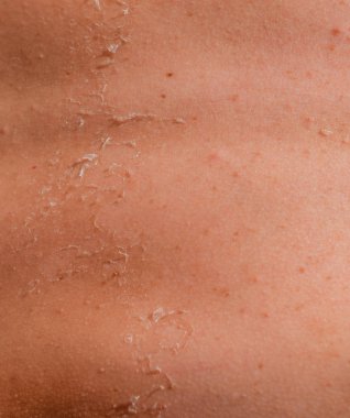 Arka ciltte güneş yanığı. Pul pul dökülme, cilt peeling. Tehlikeli güneş tan