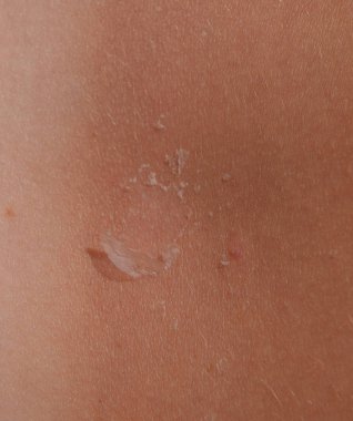 Arka ciltte güneş yanığı. Pul pul dökülme, cilt peeling. Tehlikeli güneş tan