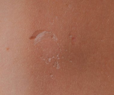 Arka ciltte güneş yanığı. Pul pul dökülme, cilt peeling. Tehlikeli güneş tan