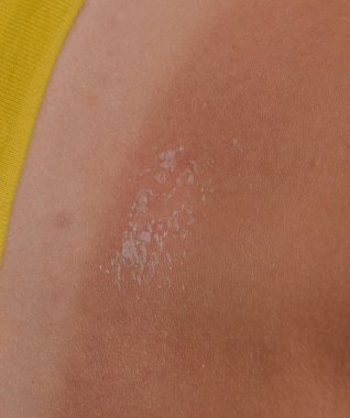 Arka ciltte güneş yanığı. Pul pul dökülme, cilt peeling. Tehlikeli güneş tan