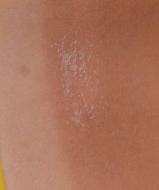 Arka ciltte güneş yanığı. Pul pul dökülme, cilt peeling. Tehlikeli güneş tan