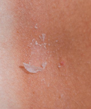 Arka ciltte güneş yanığı. Pul pul dökülme, cilt peeling. Tehlikeli güneş tan