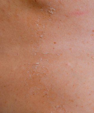 Arka ciltte güneş yanığı. Pul pul dökülme, cilt peeling. Tehlikeli güneş tan