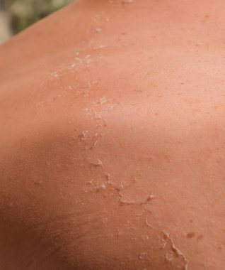 Arka ciltte güneş yanığı. Pul pul dökülme, cilt peeling. Tehlikeli güneş tan