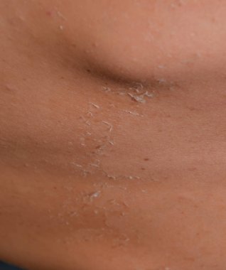 Arka ciltte güneş yanığı. Pul pul dökülme, cilt peeling. Tehlikeli güneş tan