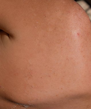 Arka ciltte güneş yanığı. Pul pul dökülme, cilt peeling. Tehlikeli güneş tan