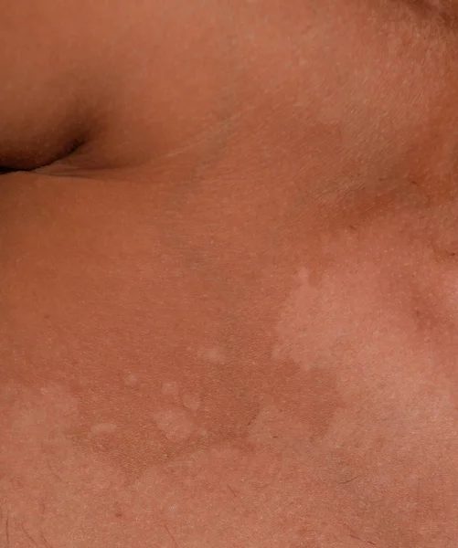 Солнечные ожоги на коже плеч. Отшелушивание, снятие кожи. Опасный загар — стоковое фото
