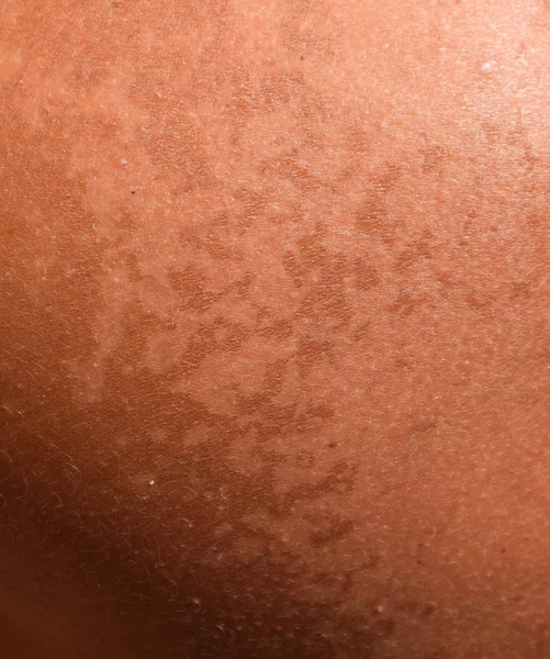 Quemaduras solares en la piel de los hombros. La exfoliación, la piel se desprende. Peligroso bronceado —  Fotos de Stock