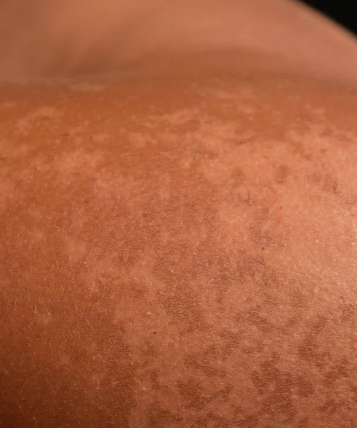 Zonnebrand op de huid van de schouders. Afschilfering, huid pelt af. Gevaarlijke zon tan — Stockfoto