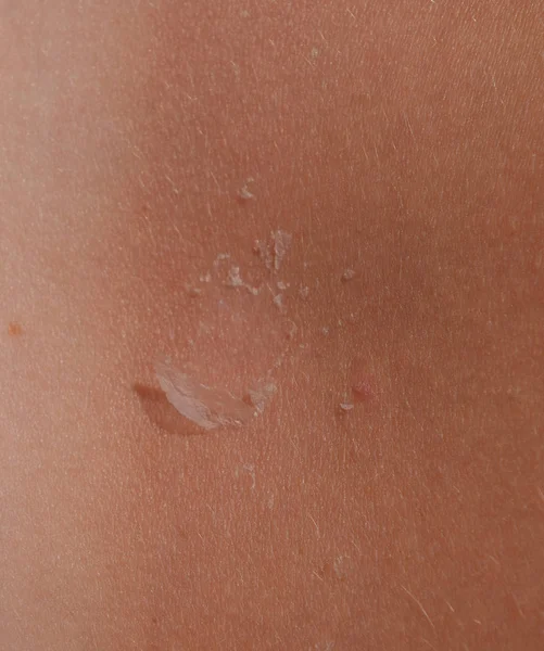 Coups de soleil sur la peau du dos. Exfoliation, peau décollée. Bronzage dangereux — Photo