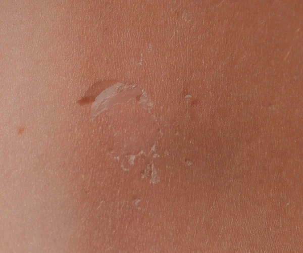 背中の皮膚に日焼け。剥離、皮膚がはがれます。危険な日焼け — ストック写真