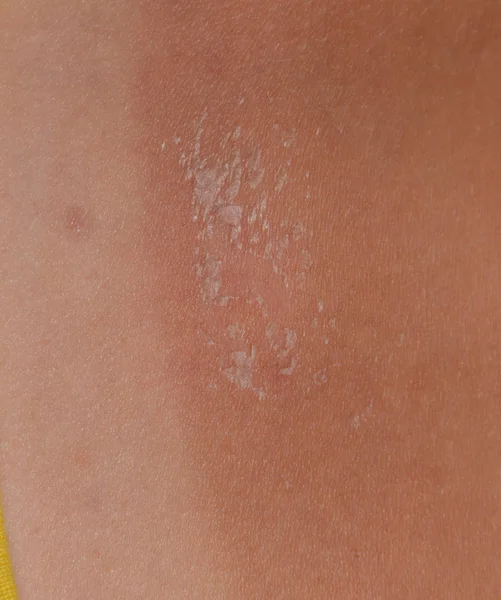 Arka ciltte güneş yanığı. Pul pul dökülme, cilt peeling. Tehlikeli güneş tan