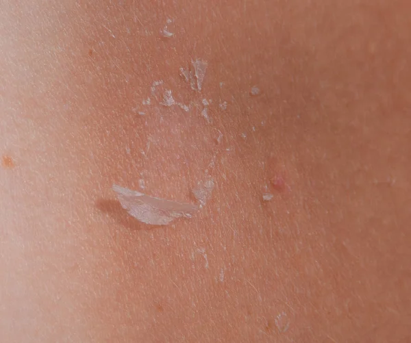 Quemaduras solares en la piel de la espalda. La exfoliación, la piel se desprende. Peligroso bronceado — Foto de Stock