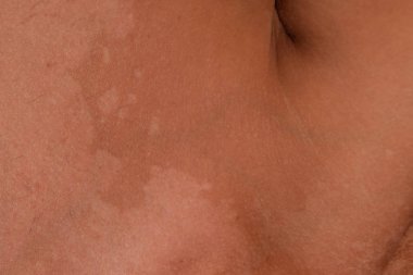 Omuz cilt üzerinde güneş yanığı. Pul pul dökülme, cilt peeling. Tehlikeli güneş tan