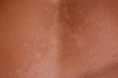 Mide cilt üzerinde güneş yanığı. Pul pul dökülme, cilt peeling. Tehlikeli güneş tan