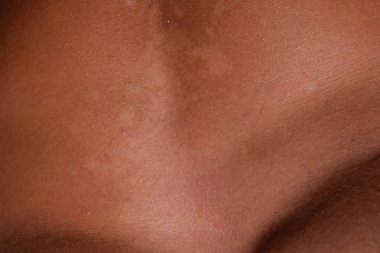 Mide cilt üzerinde güneş yanığı. Pul pul dökülme, cilt peeling. Tehlikeli güneş tan