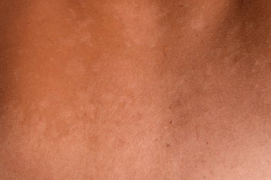 Arka ciltte güneş yanığı. Pul pul dökülme, cilt peeling. Tehlikeli güneş tan