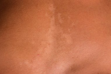 Mide cilt üzerinde güneş yanığı. Pul pul dökülme, cilt peeling. Tehlikeli güneş tan