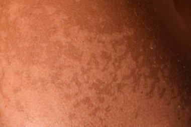 Omuz cilt üzerinde güneş yanığı. Pul pul dökülme, cilt peeling. Tehlikeli güneş tan