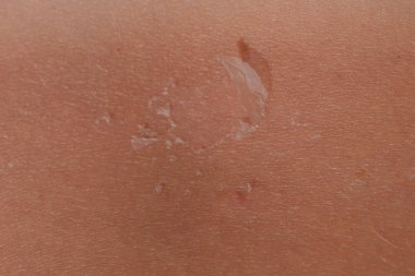 Arka ciltte güneş yanığı. Pul pul dökülme, cilt peeling. Tehlikeli güneş tan