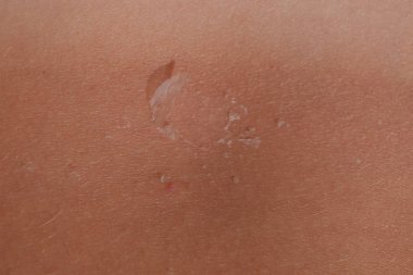 Arka ciltte güneş yanığı. Pul pul dökülme, cilt peeling. Tehlikeli güneş tan