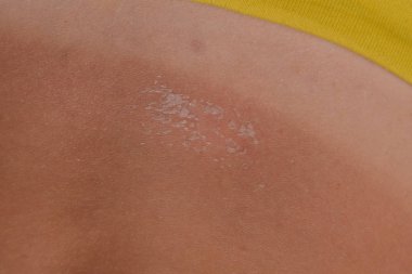 Arka ciltte güneş yanığı. Pul pul dökülme, cilt peeling. Tehlikeli güneş tan