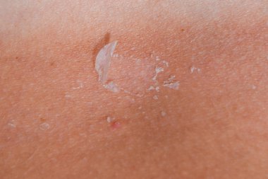 Arka ciltte güneş yanığı. Pul pul dökülme, cilt peeling. Tehlikeli güneş tan