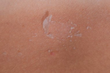 Arka ciltte güneş yanığı. Pul pul dökülme, cilt peeling. Tehlikeli güneş tan