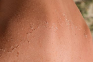 Arka ciltte güneş yanığı. Pul pul dökülme, cilt peeling. Tehlikeli güneş tan