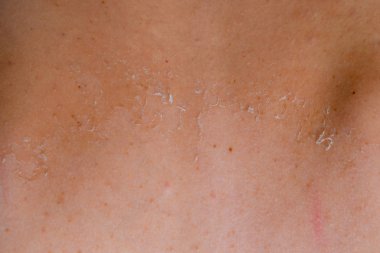 Arka ciltte güneş yanığı. Pul pul dökülme, cilt peeling. Tehlikeli güneş tan