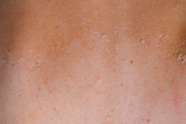 Arka ciltte güneş yanığı. Pul pul dökülme, cilt peeling. Tehlikeli güneş tan