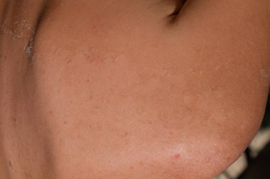 Arka ciltte güneş yanığı. Pul pul dökülme, cilt peeling. Tehlikeli güneş tan