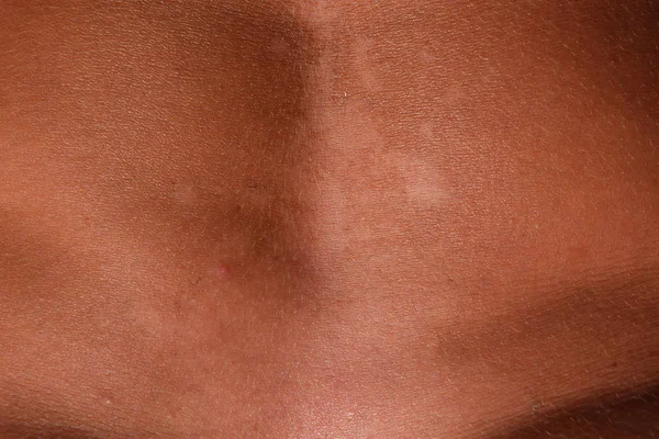 Mide cilt üzerinde güneş yanığı. Pul pul dökülme, cilt peeling. Tehlikeli güneş tan