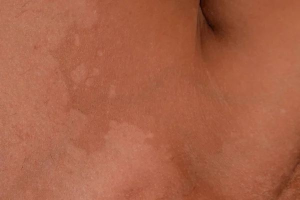 Quemaduras solares en la piel de los hombros. La exfoliación, la piel se desprende. Peligroso bronceado — Foto de Stock