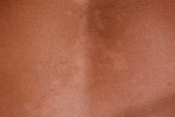 Quemaduras solares en la piel del estómago. La exfoliación, la piel se desprende. Peligroso bronceado —  Fotos de Stock