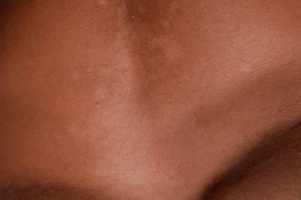 Quemaduras solares en la piel del estómago. La exfoliación, la piel se desprende. Peligroso bronceado —  Fotos de Stock