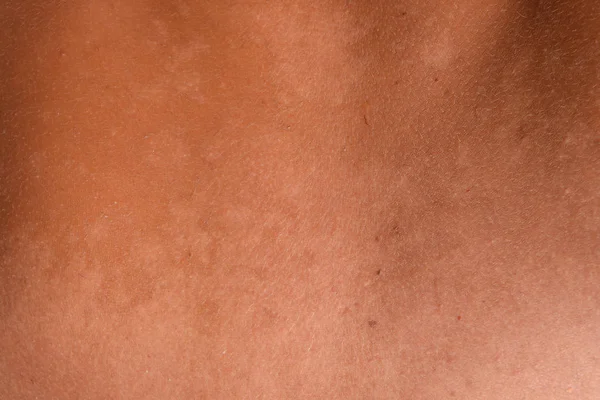 Arka ciltte güneş yanığı. Pul pul dökülme, cilt peeling. Tehlikeli güneş tan