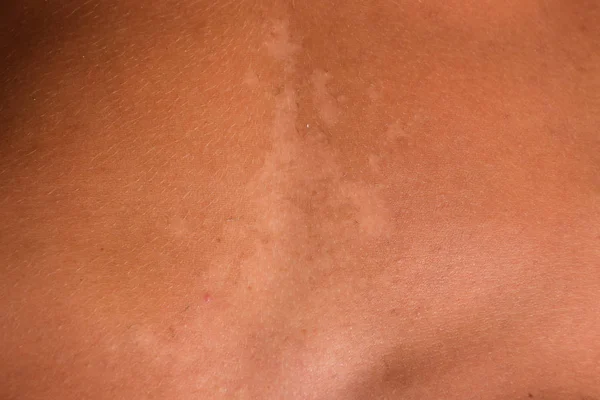 Quemaduras solares en la piel del estómago. La exfoliación, la piel se desprende. Peligroso bronceado — Foto de Stock