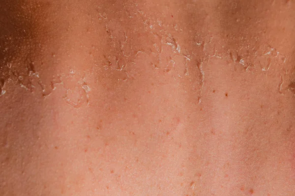 Sunburn on the skin of the back. Exfoliation, skin peels off. Dangerous sun tan — Stock Photo, Image