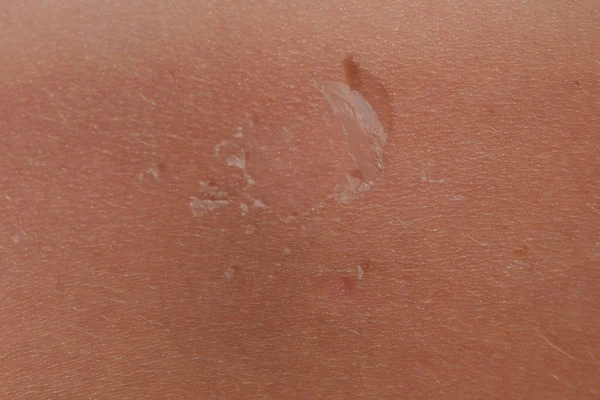 Quemaduras solares en la piel de la espalda. La exfoliación, la piel se desprende. Peligroso bronceado — Foto de Stock