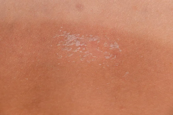 Quemaduras solares en la piel de la espalda. La exfoliación, la piel se desprende. Peligroso bronceado — Foto de Stock