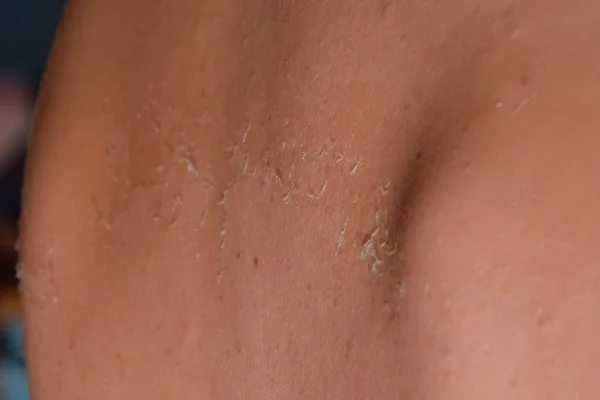 Ηλιακό έγκαυμα στο δέρμα της πλάτης. Απολέπιση, δέρμα ξεφλουδίζει μακριά. Επικίνδυνη μαύρισμα — Φωτογραφία Αρχείου
