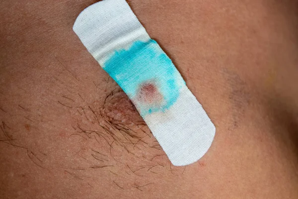 Bactericidal adhesive tape on the male nipple