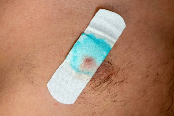 Bactericidal adhesive tape on the male nipple