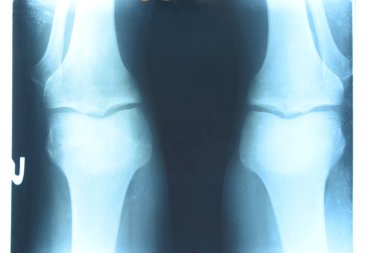 Diz eklemlerinin röntgeni, x-ray üzerinde diz kemiklerinin bir resmi.