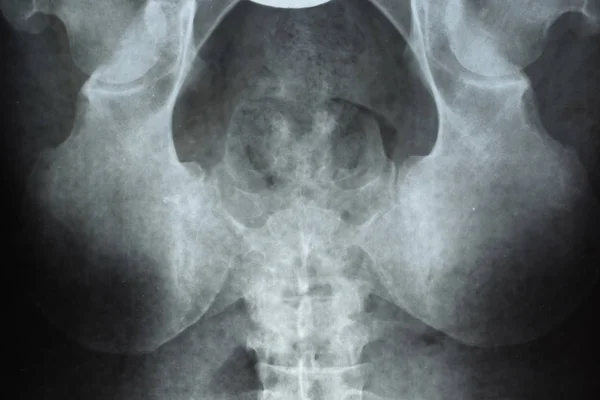 Рентген таза и крестца. Рентген — стоковое фото