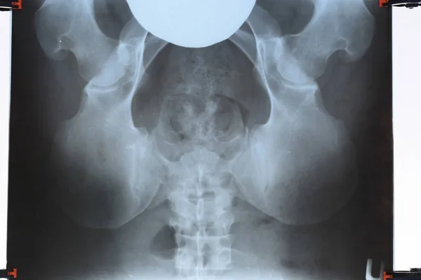 Radiographie du bassin et du sacrum. Radiographie — Photo